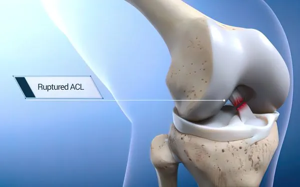 Why Soccer Players Are at Higher Risk of ACL Injuries